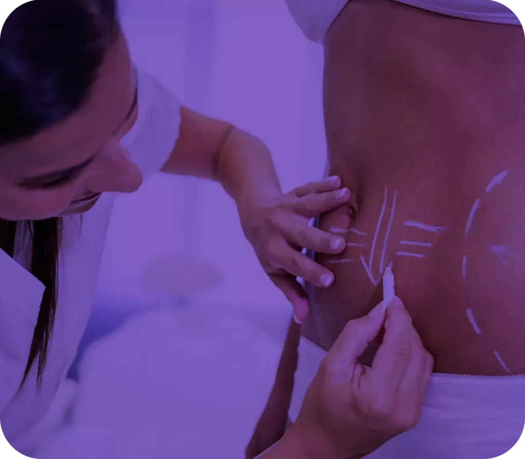 cirurgiao-desenhando-linhas-no-abdomen-da-mulher-para-remocao-de-lipoaspiracao-e-celulite-