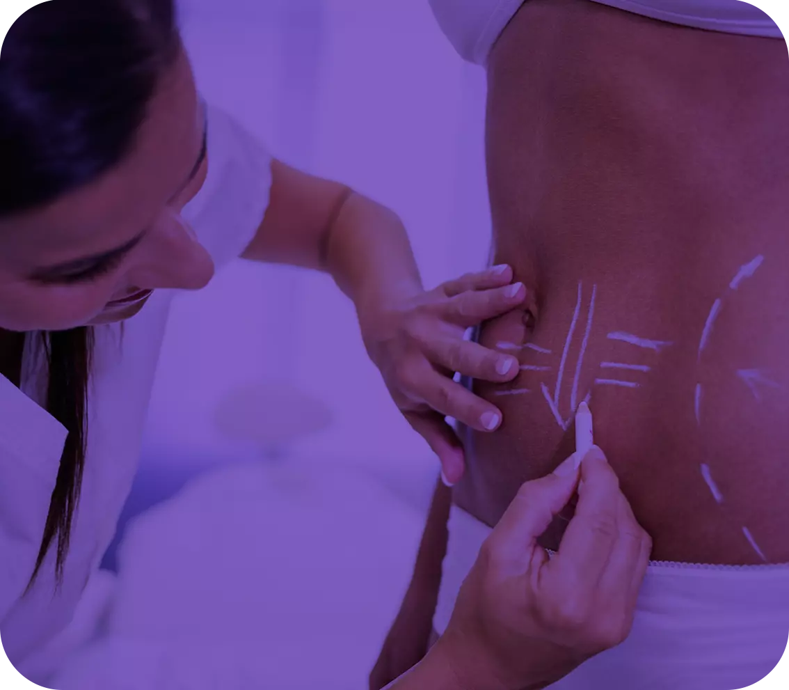 cirurgiao-desenhando-linhas-no-abdomen-da-mulher-para-remocao-de-lipoaspiracao-e-celulite-